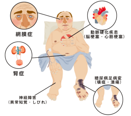 糖尿病の合併症